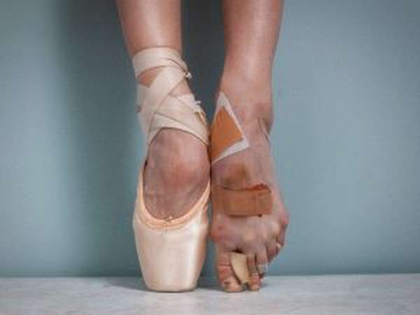 Занятие бальными танцами - причина перелома плюсневой кости стопы